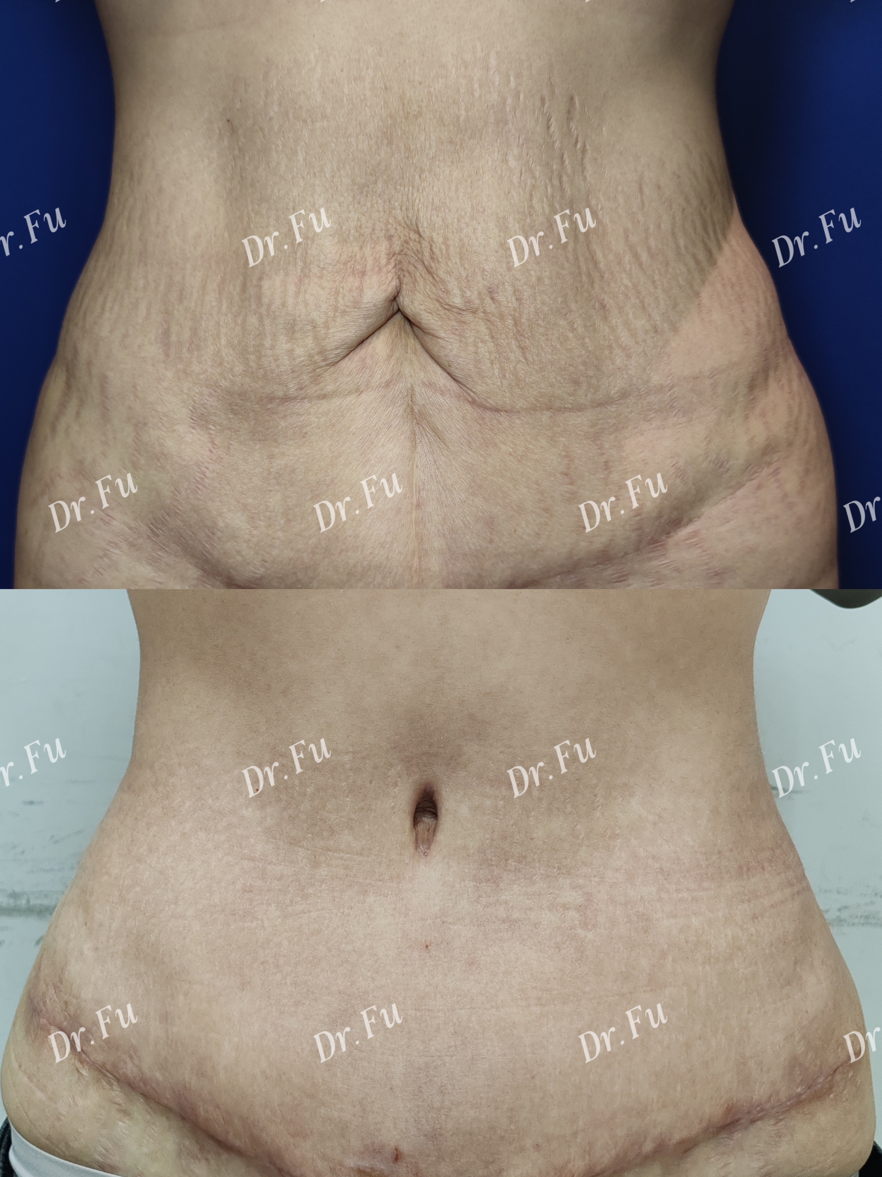 Abdominoplasty Case 2
